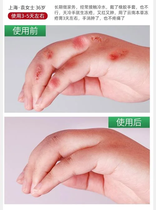 梦见冻疮膏_2