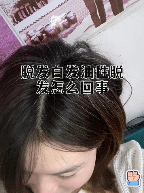 梦见头发变白并脱发_2