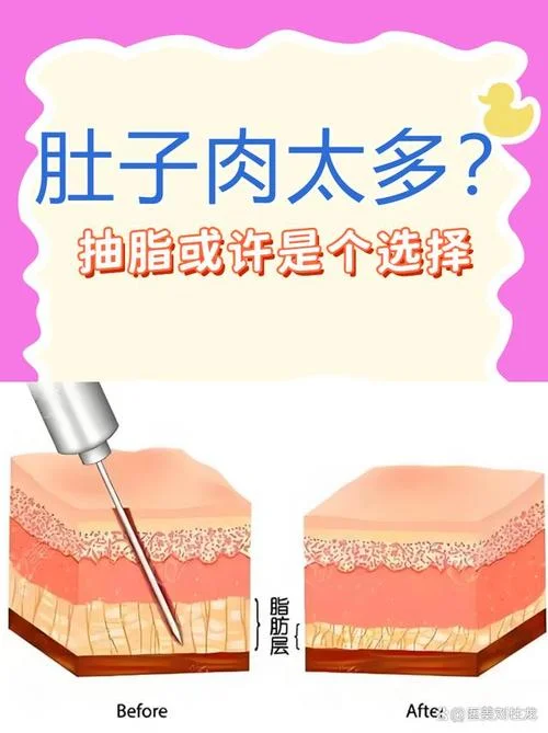 抽脂减肥大概需要多少钱-抽脂减肥费用参考