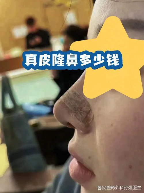 去韩国隆鼻需要多少钱_2