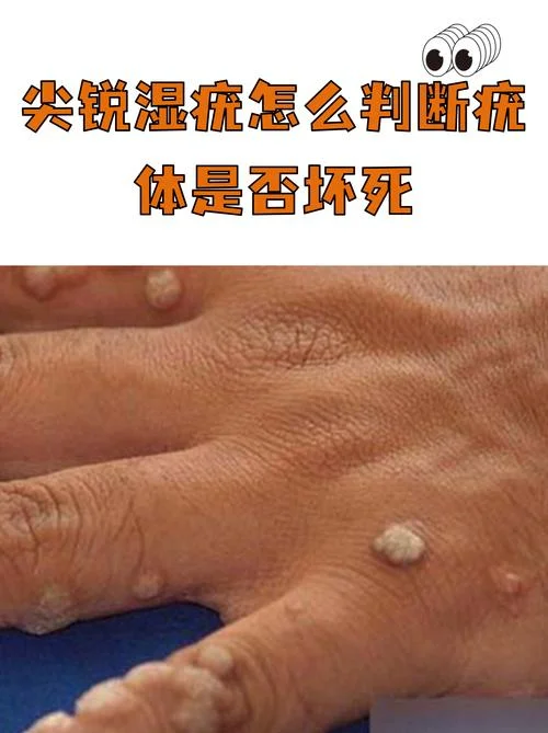 什么是尖锐湿扰_1