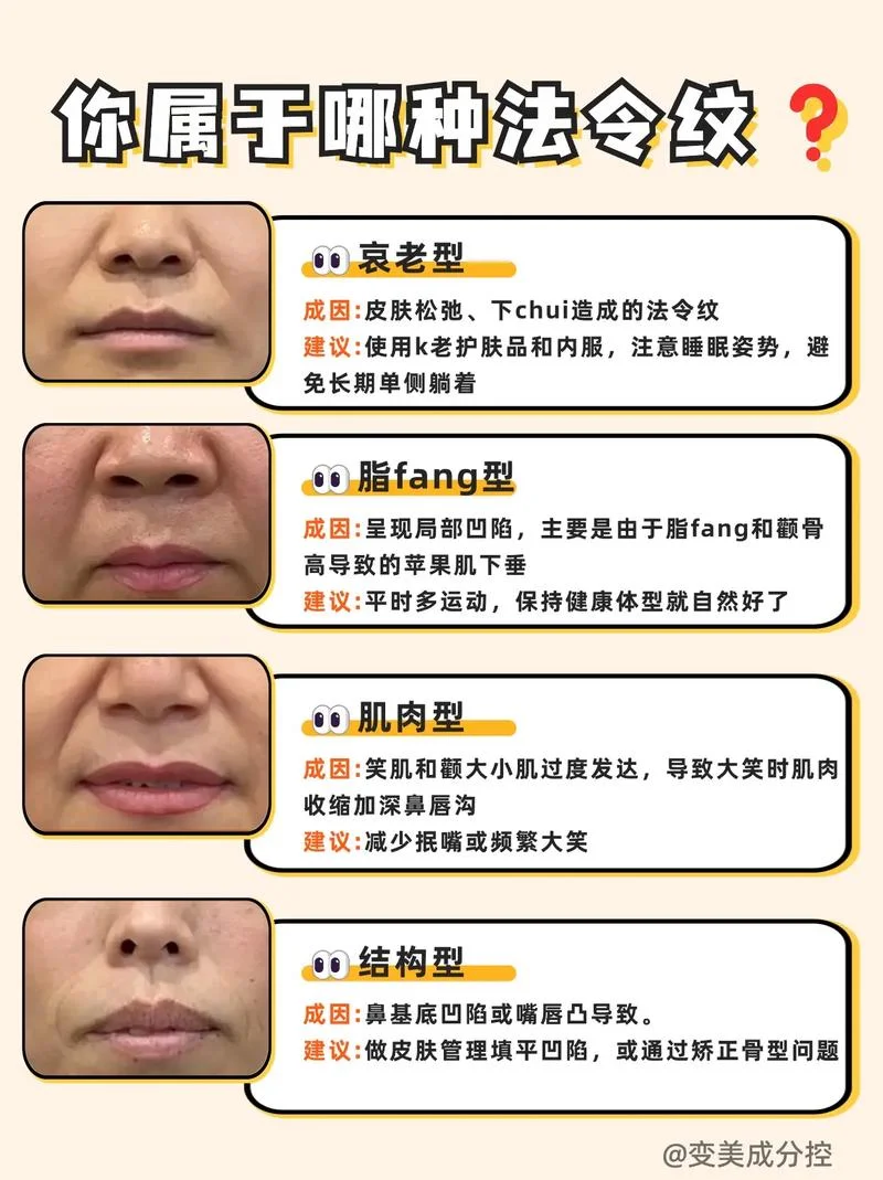 法令纹填充多少钱一针_2