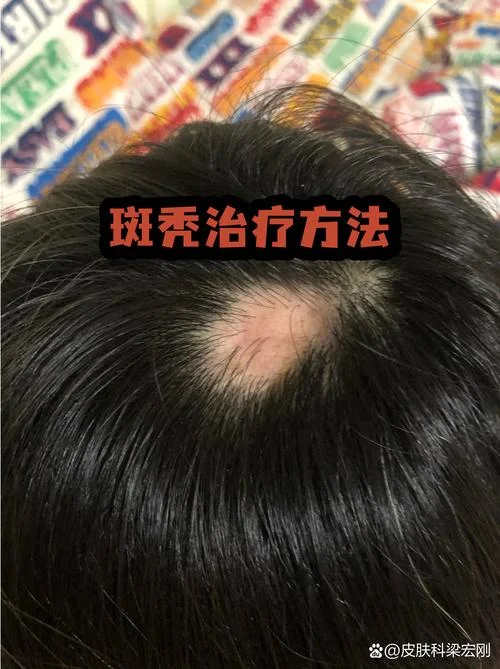 梦见儿子斑秃_2
