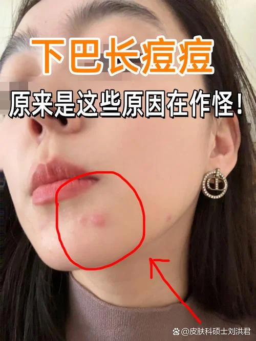 嘴下面起了一个痘痘怎么办_1
