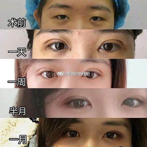 哪里学做双眼皮手术_1