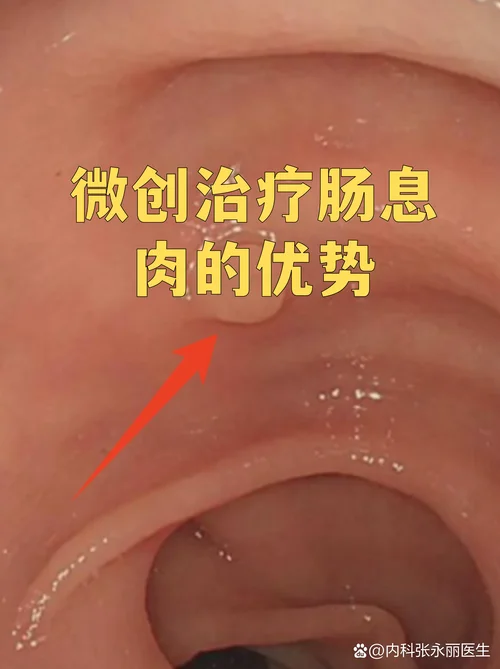 息肉一年会长多大_1