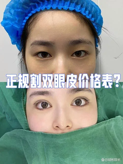 开双眼皮一般需要多少钱-开双眼皮约 3000-8000 元