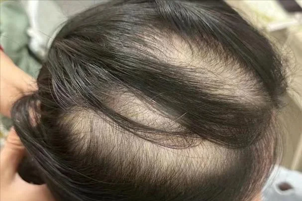 女人梦见掉头发秃顶_2