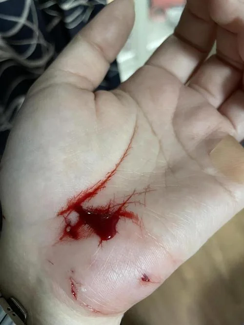 梦见猫咬我的眼_1