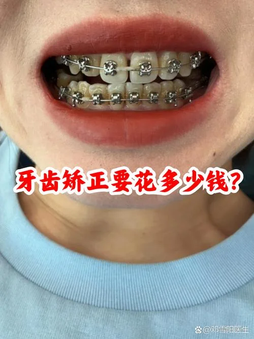 门牙矫正一般需要多少钱_1