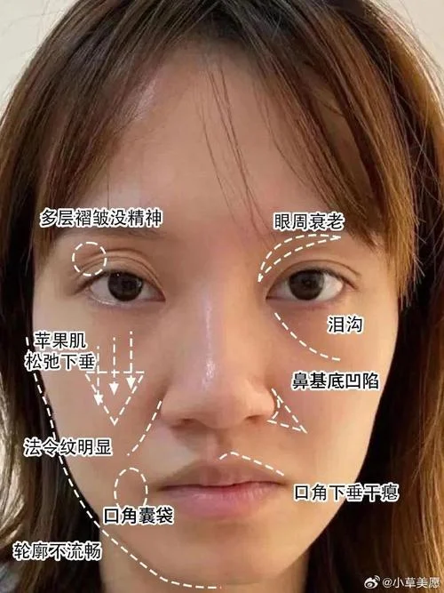 玻尿酸鼻唇沟多少钱_1
