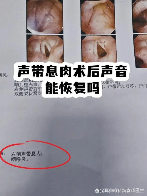 声带息肉切除多少钱_1
