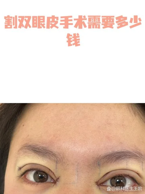 眼睑松弛多少钱_1