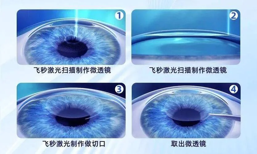 全飞秒是什么意思-全飞秒是什么意思