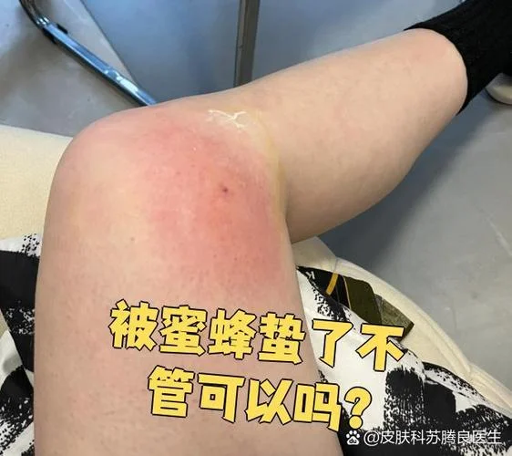 做梦梦到蜜蜂蛰自己_2