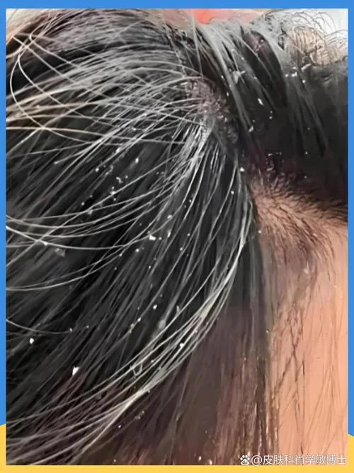 梦见头发掉白头皮屑_1