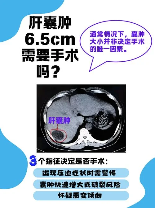 什么是肝囊性占位_1