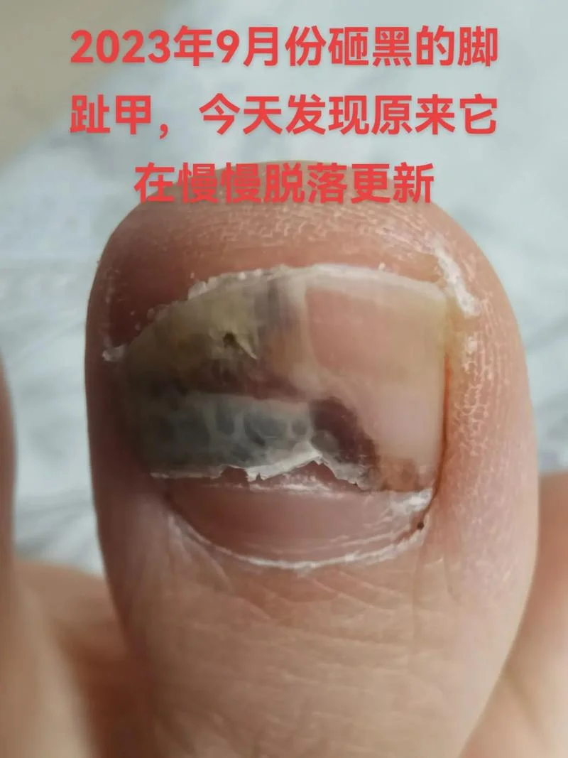 梦见脚指甲全都脱掉_1