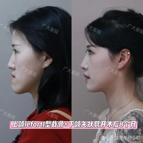 成人地包天矫正要多少钱_2