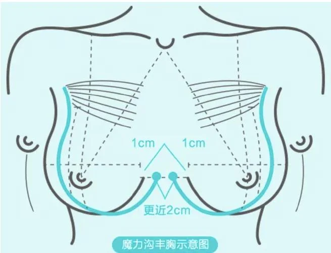 成都丰胸一般多少钱_1