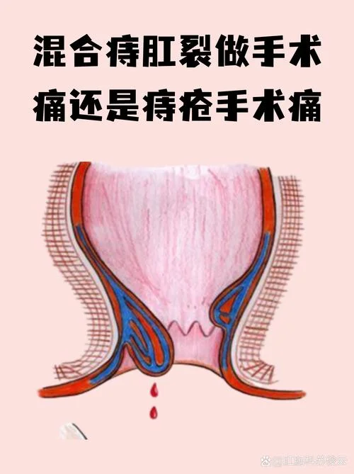 肛裂痔疮手术多少钱_1