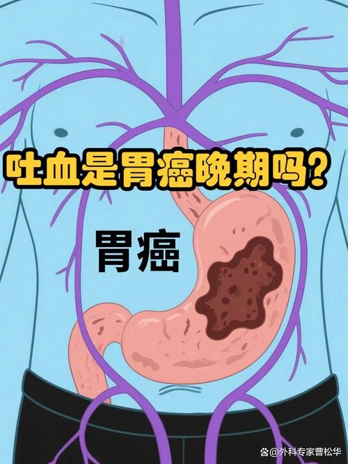 梦见自己得了胃癌晚期_2