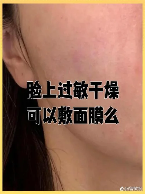 梦见面膜过敏脸上长痘_1