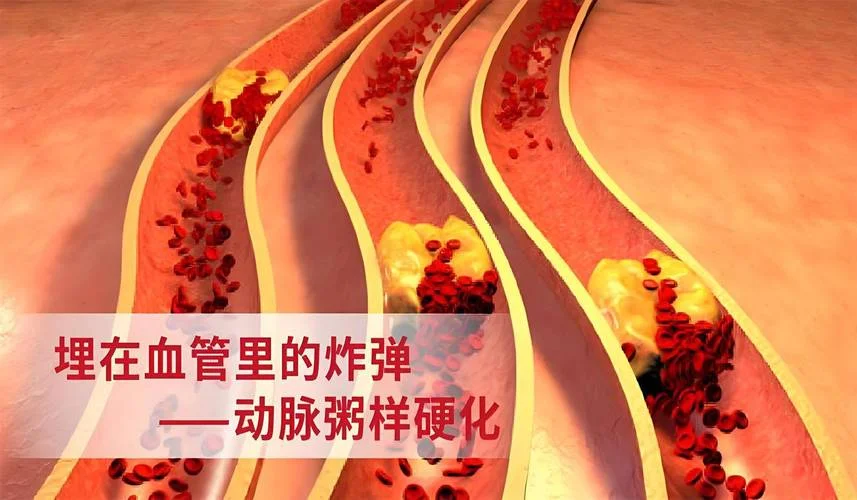 什么是粥样动脉硬化_2