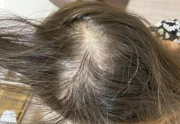 什么是内分泌脱发_2