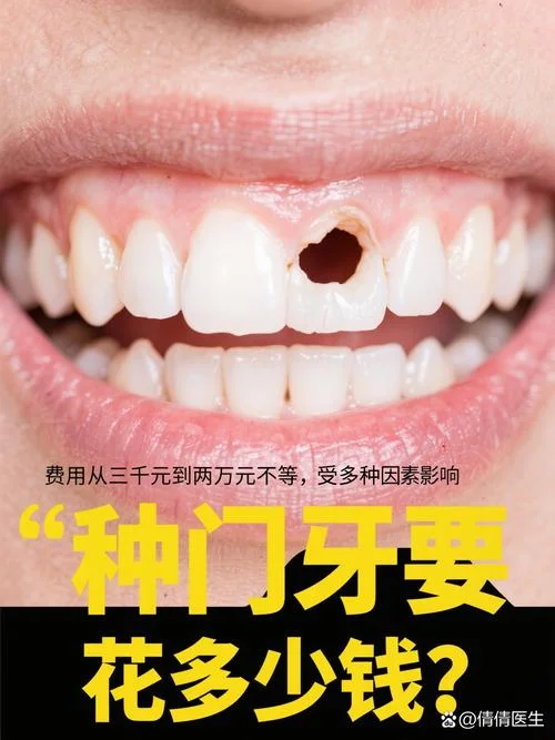 种个门牙多少钱_1