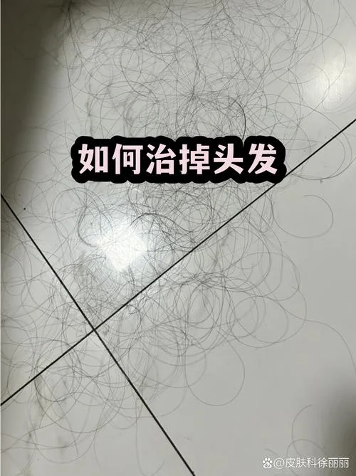 做梦大把掉头发什么意思_1
