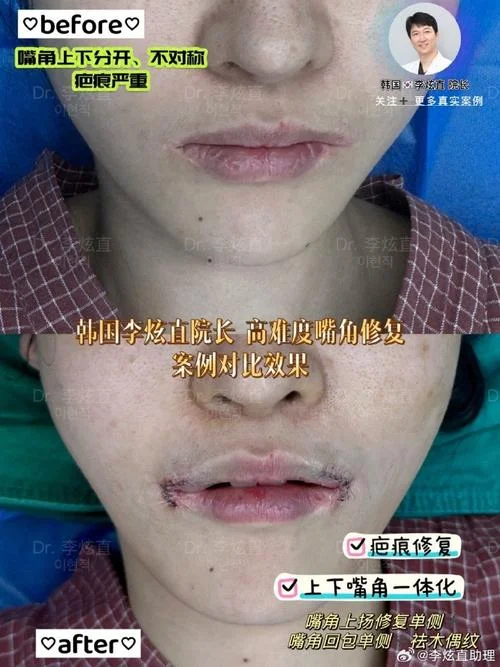 嘴角上扬怎么做手术_1