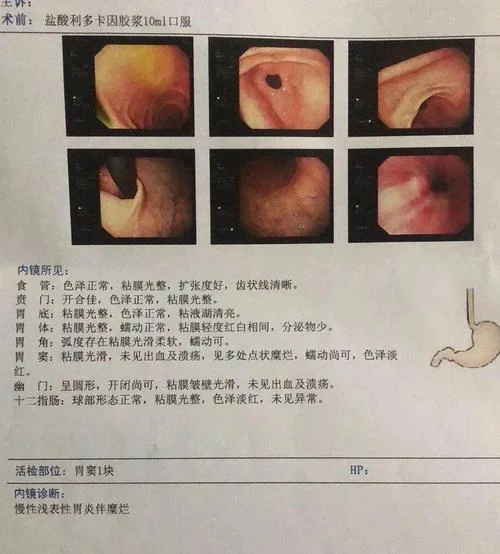 胃镜如何查_1