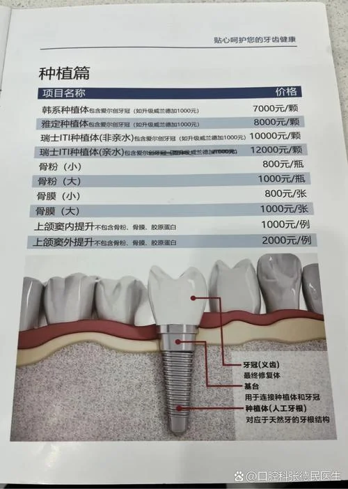 现在种牙要多少钱-现在种牙要多少