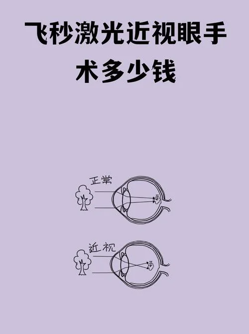激光视力手术多少钱_1