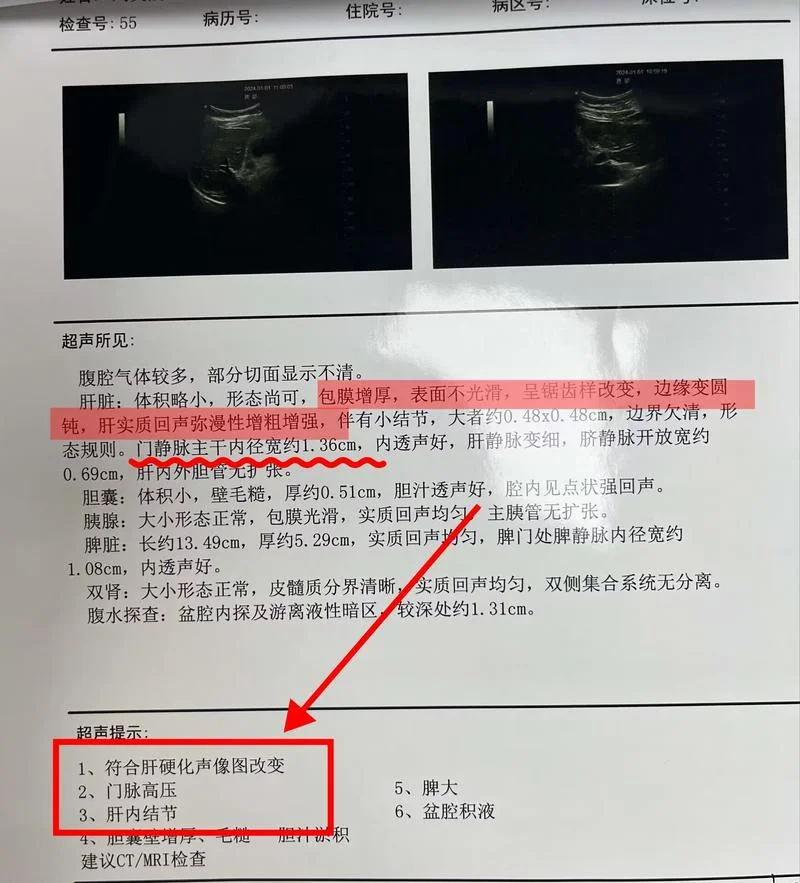 肝硬化腹水病历怎么写_2
