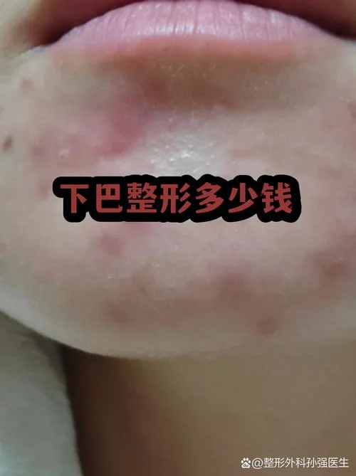 整形手术的多少钱_2