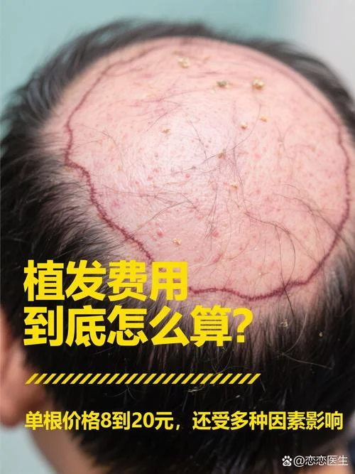 植头发得多少钱_2