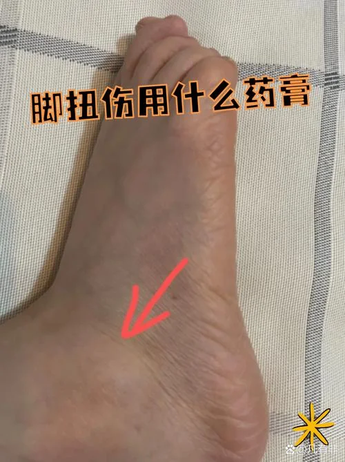 脚扭伤复发怎么办-脚扭伤复发怎么办