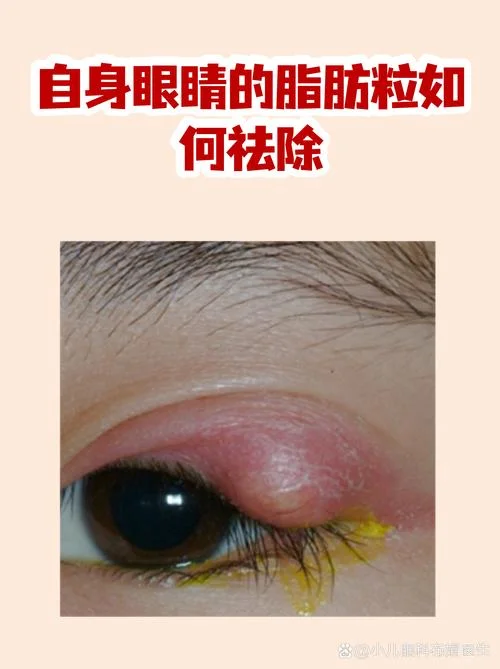 眼睑长脂肪粒怎么办-眼睑脂肪粒如何处理