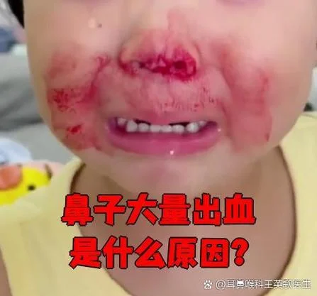 做梦流了好多鼻血_1