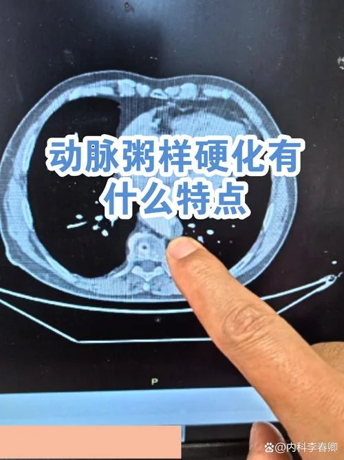 什么是粥样动脉硬化_1