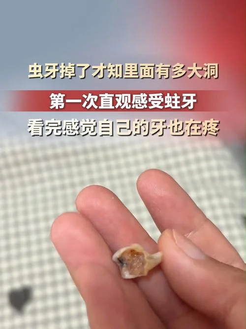 梦见自己拔掉一个虫牙_1