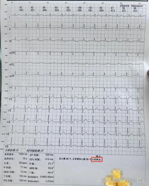 窦性心律过缓伴不齐是什么意思_1