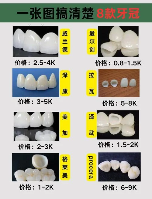 镶牙大约要多少钱_2