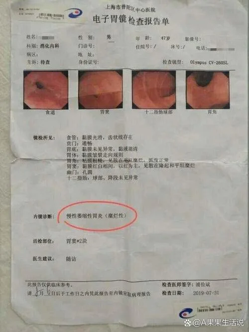 胃炎伴糜烂是什么意思_1