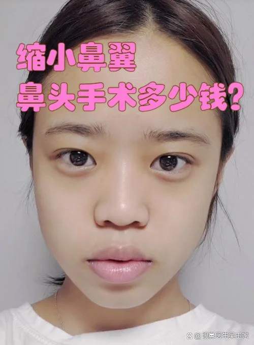 鼻头大整形要多少钱_2