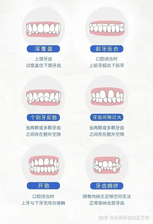 牙齿矫正一颗多少钱一颗_1