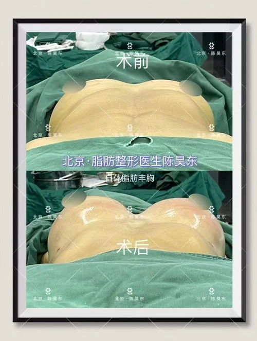 自体脂肪填充丰胸多少钱_2