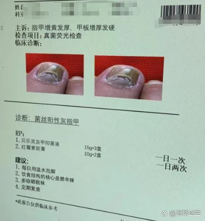 10个灰指甲大概多少钱_2